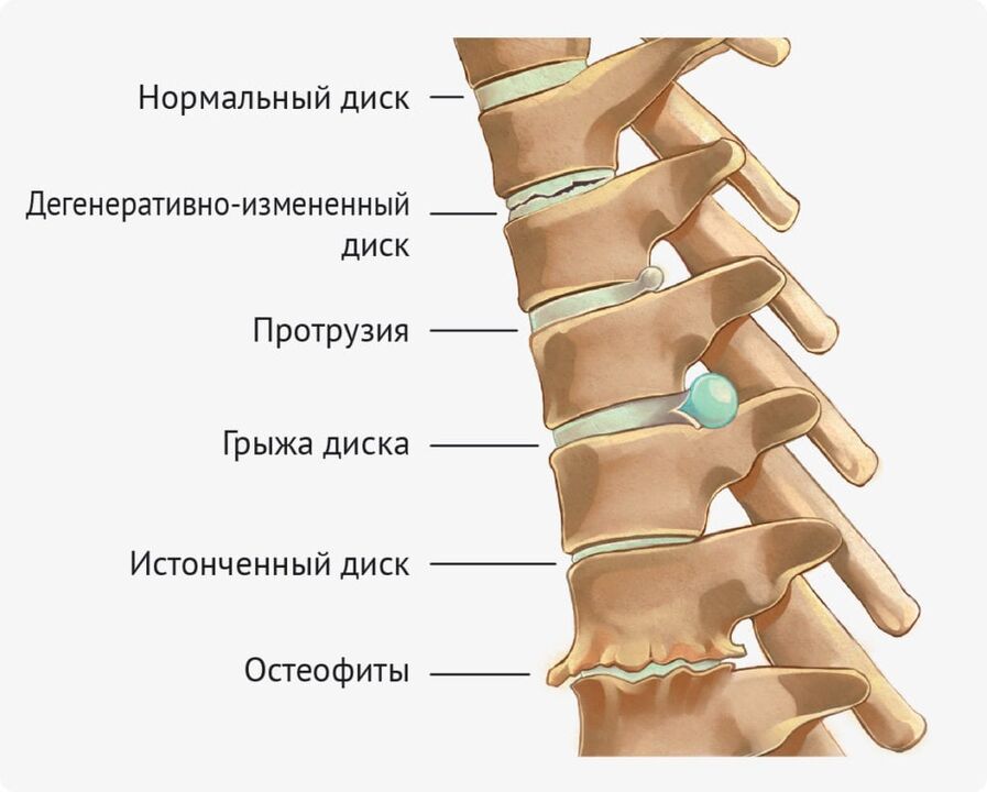 Deformidades de disco para la osteocondrosis lumbar