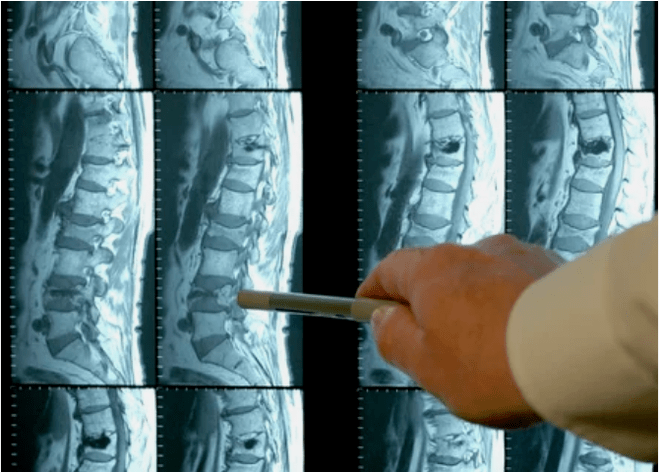 Variedades de osteocondrosis en la columna vertebral