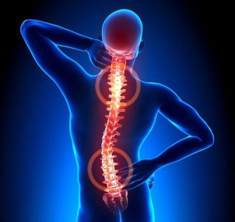 Osteocondrosis de la columna