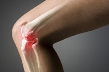 La artrosis de la articulación de la rodilla es una lesión del tejido de cartílago