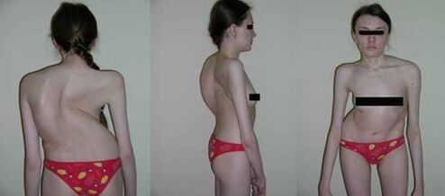 curvatura de la columna como consecuencia de la osteocondrosis