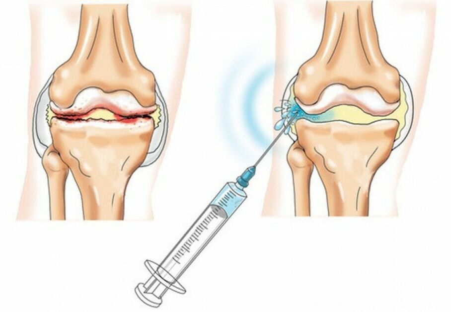 inyección en la articulación de la rodilla con artrosis