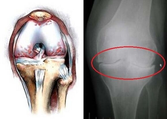 osteoartritis de la articulación de la rodilla