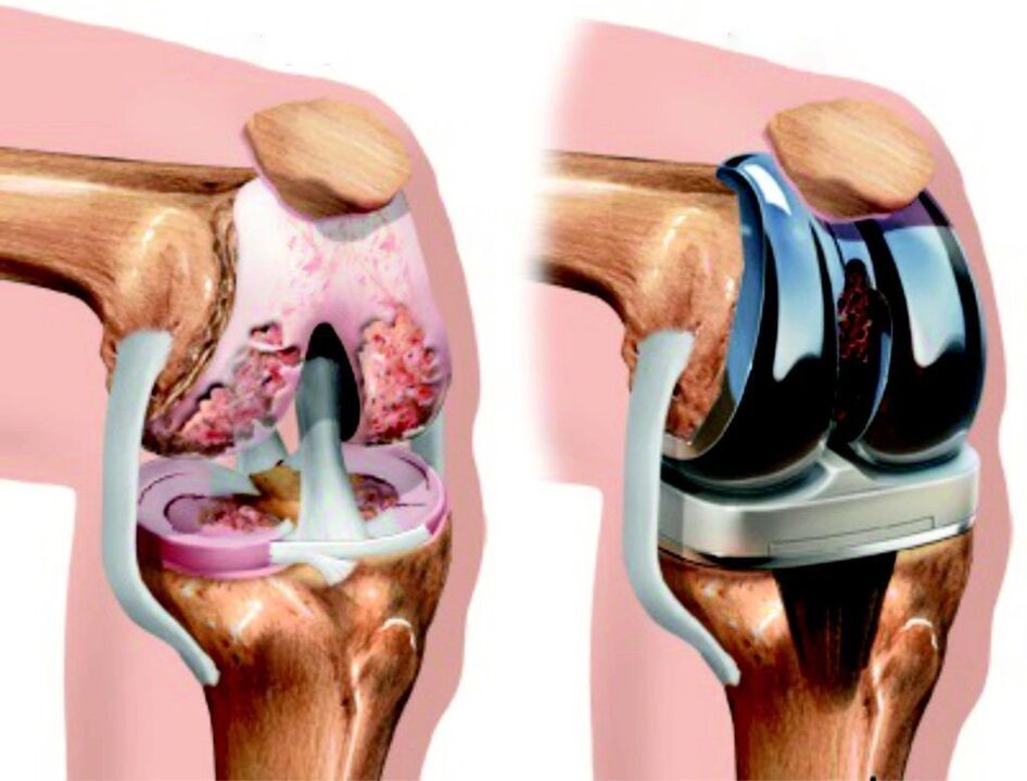 En caso de daño total de la articulación de la rodilla por artrosis, se puede restaurar mediante endoprótesis. 