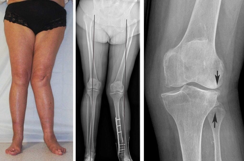 La artrosis avanzada de las articulaciones de la rodilla es claramente visible incluso sin radiografías. 