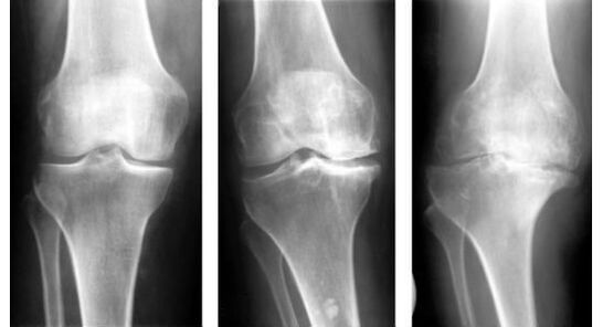Una medida de diagnóstico obligatoria al identificar la artrosis de la rodilla es una radiografía. 
